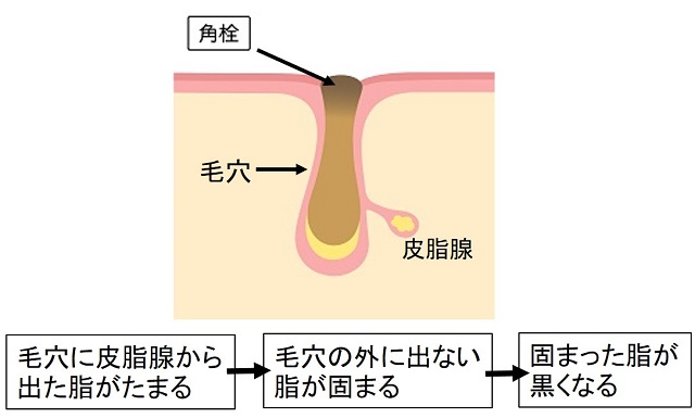 鼻の毛穴の脂が固まって黒くなることを説明した図1